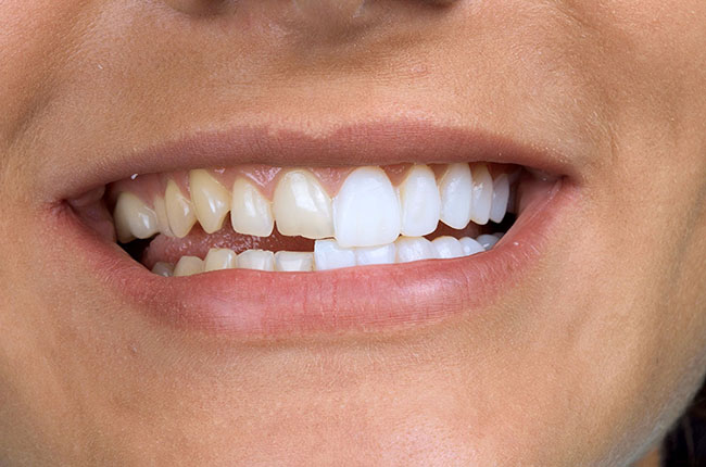 استفاده از مسواک نرم برای ونیر
