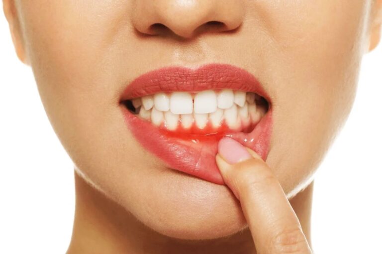 در چه صورتی خون ریزی لثه را جدی بگیریم؟