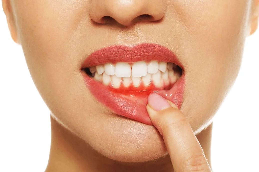 در چه صورتی خون ریزی لثه را جدی بگیریم؟