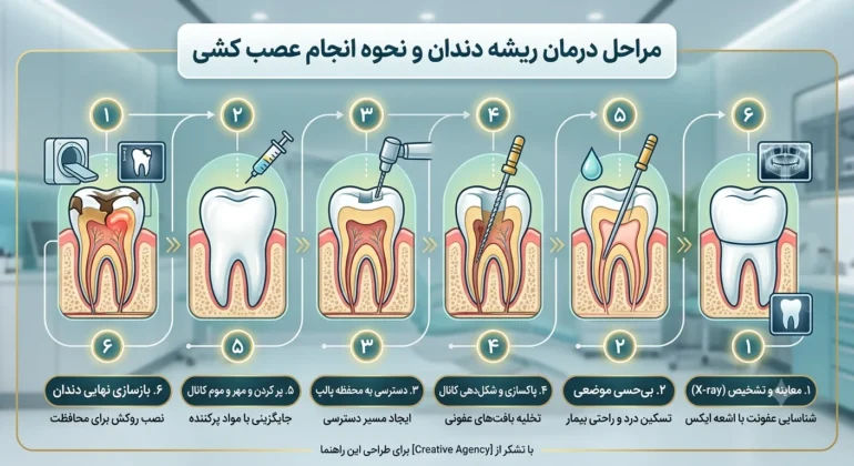 مراحل درمان ریشه دندان و نحوه انجام عصب کشی