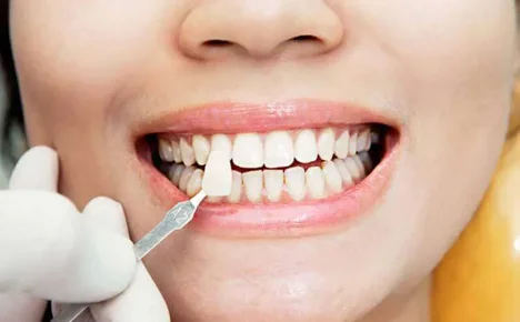 طراحی لبخند با لمینت دندان