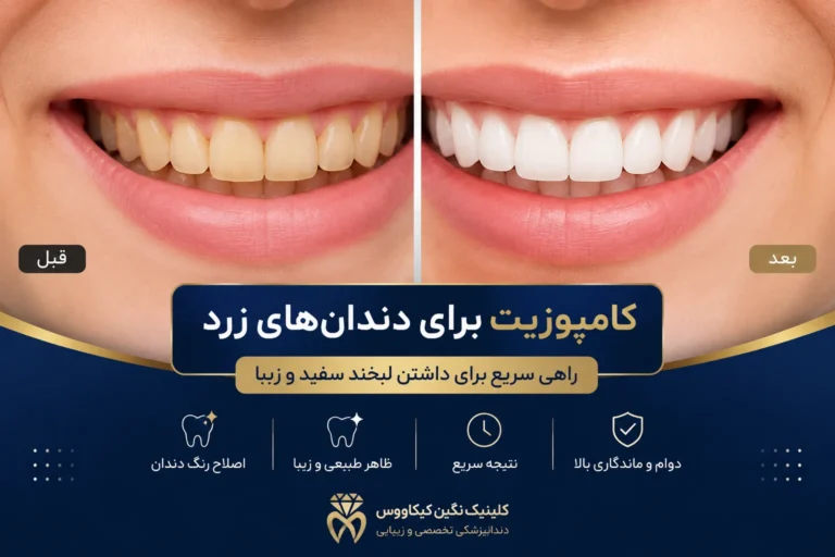 کامپوزیت برای دندانهای زرد قبل و بعد از درمان زیبایی دندان