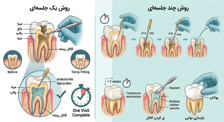تفاوت عصب کشی یک جلسه ای و چند جلسه ای