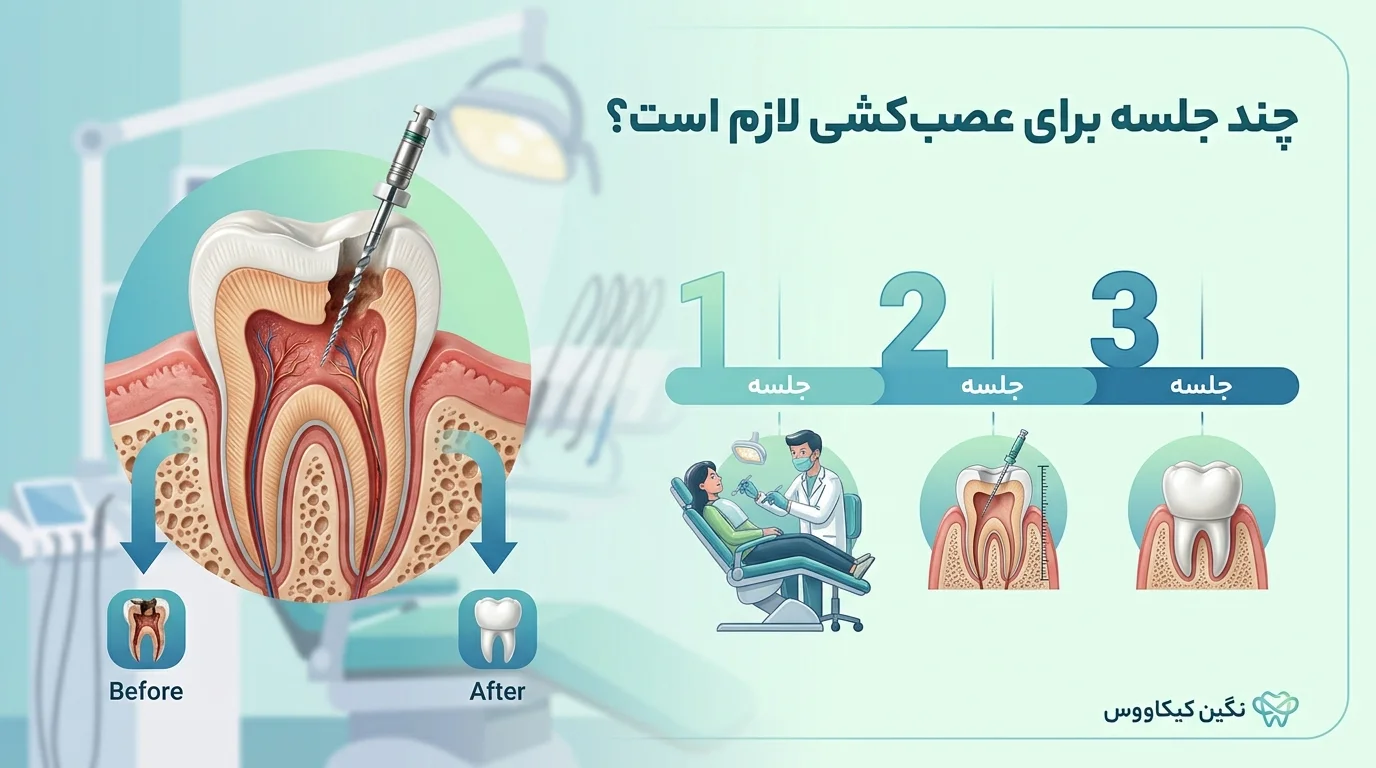 چند جلسه برای عصب کشی لازم است