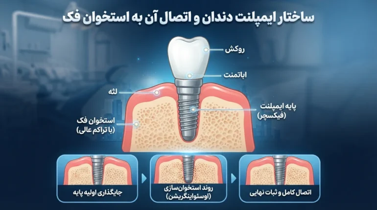 ساختار ایمپلنت دندان و اتصال پایه ایمپلنت به استخوان فک