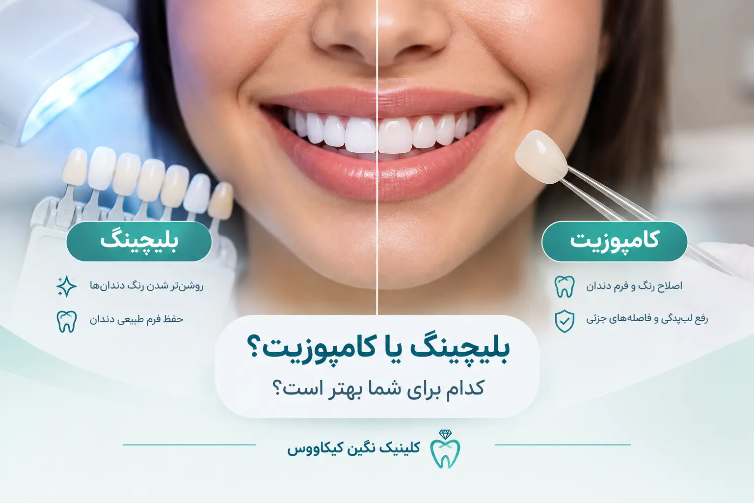 مقایسه بلیچینگ یا کامپوزیت دندان