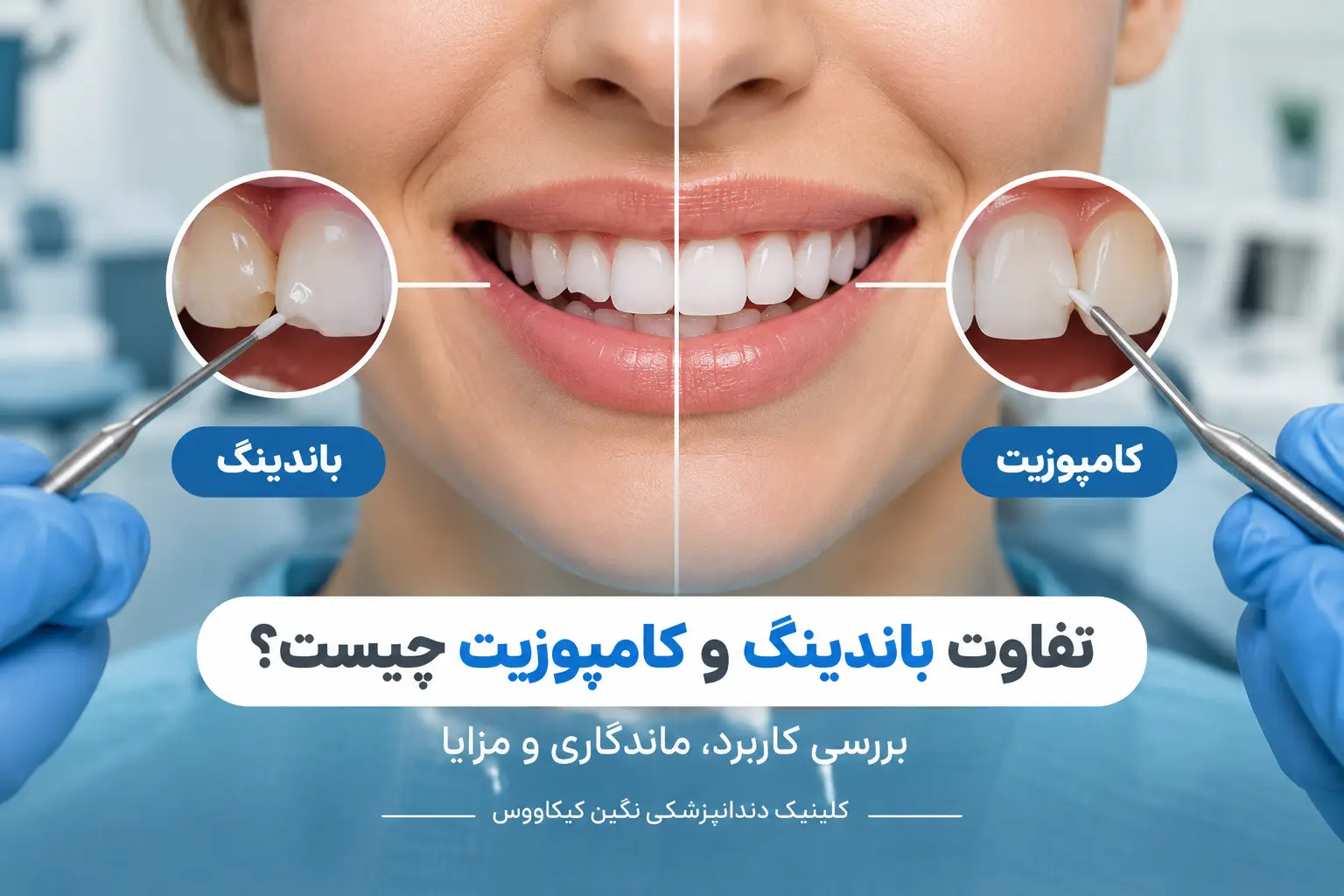 تفاوت باندینگ و کامپوزیت دندان