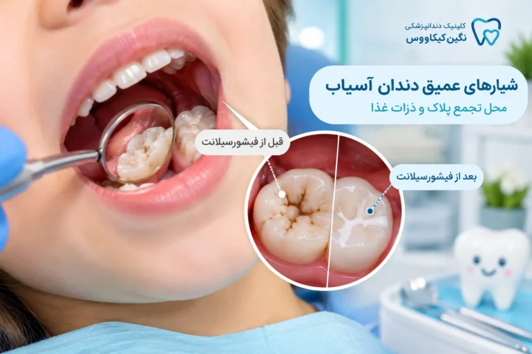 فیشورسیلانت روی شیار دندان آسیاب کودک