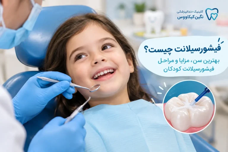 فیشورسیلانت دندان کودکان برای پیشگیری از پوسیدگی