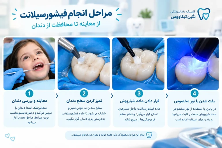 مراحل انجام فیشورسیلانت برای کودک