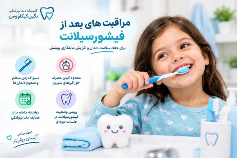 مراقبت از دندان کودک بعد از فیشورسیلانت
