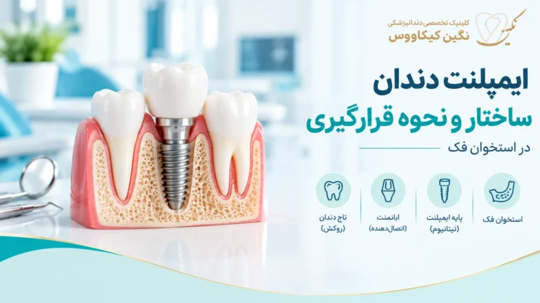 ساختار ایمپلنت دندان و قرارگیری پایه در استخوان فک