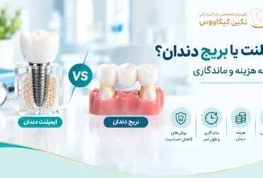 مقایسه ایمپلنت و بریج دندان برای جایگزینی دندان ازدسترفته