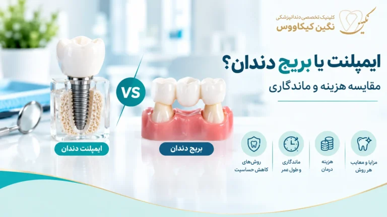 مقایسه ایمپلنت و بریج دندان برای جایگزینی دندان ازدسترفته