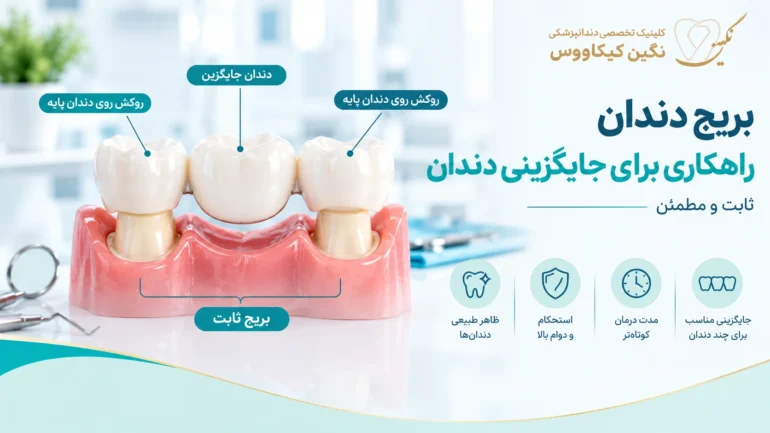 بریج دندان ثابت با تکیه بر دندانهای مجاور