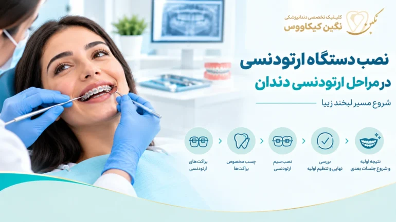 نصب براکت‌های ارتودنسی ثابت روی دندان‌ها