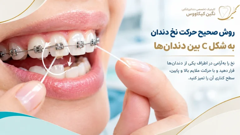 عبور نخ دندان از زیر سیم ریتینر ثابت پس از ارتودنسی