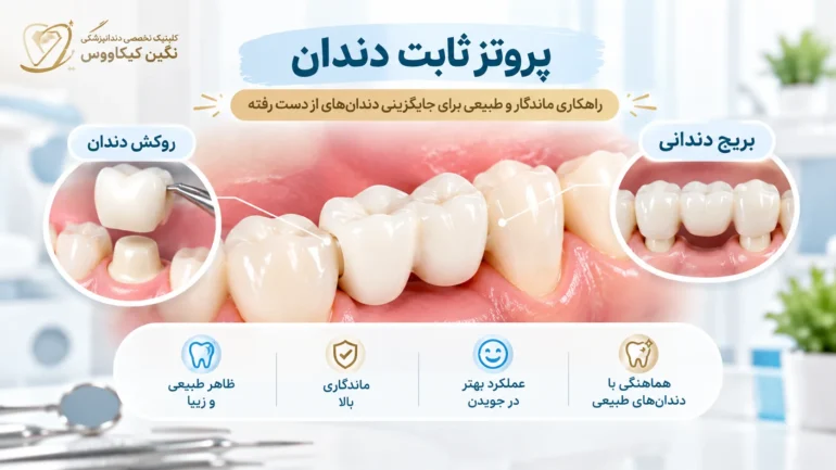 پروتز ثابت دندان روی دندانهای پایه برای جایگزینی دندان ازدسترفته